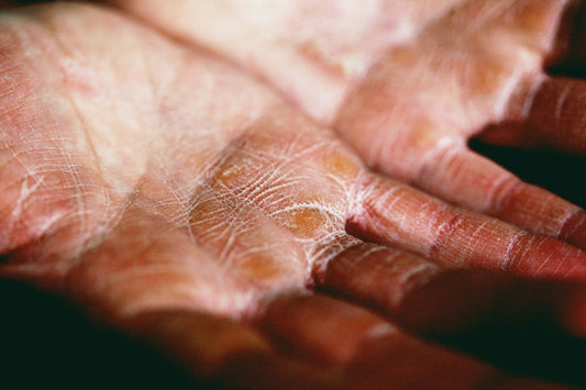 Eczema and Steroid Creams