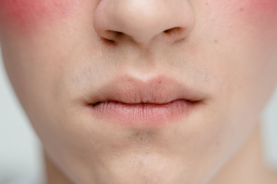 The Rosacea Puzzle: What's Actually Happening Under Your Skin
