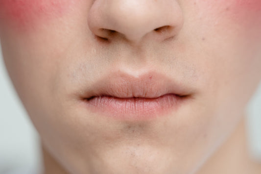 The Rosacea Puzzle: What's Actually Happening Under Your Skin
